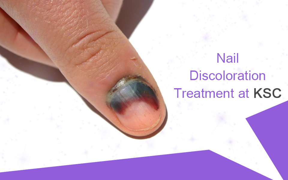 purple discoloration of the nails