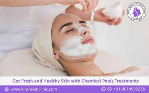 #ChemicalPeels_Treatments