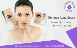 #Acne_Scars_Treatment