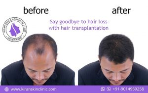#HairLoss_Treatment_for_Men