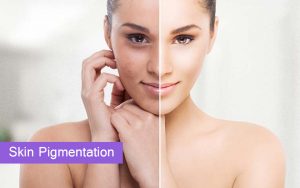 Skin Pigmentation Treatment in Hyderabad