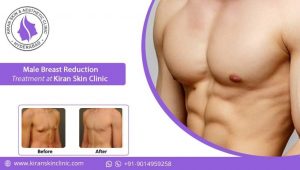 Male Breast Reduction Treatment in Hyderabad