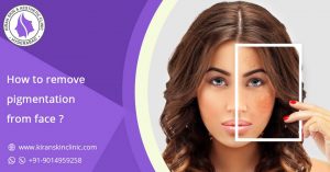 Pigmentation Treatment in Hyderabad