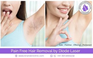 laser hair removal treatment in hyderabad