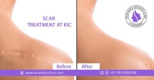 Scar treatment in Hyderabad