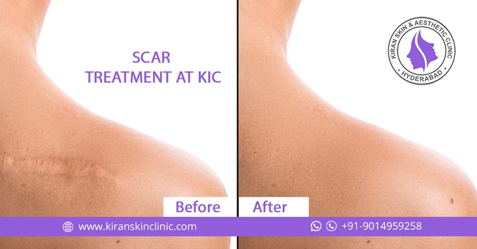 Scar treatment in Hyderabad