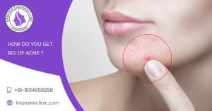 Acne Scar Treatment In Hyderabad