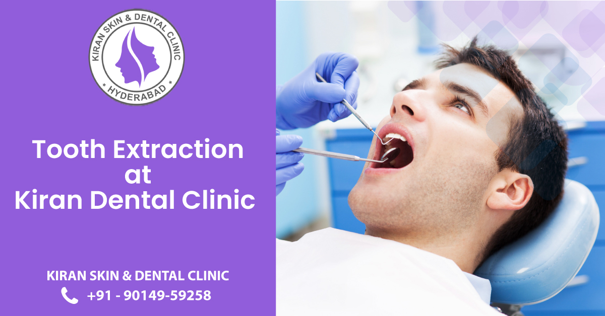 #Tooth_Extraction_Treatment_in_Hyderabad