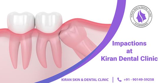 Tooth_Impaction_Treatment_in_Hyderabad