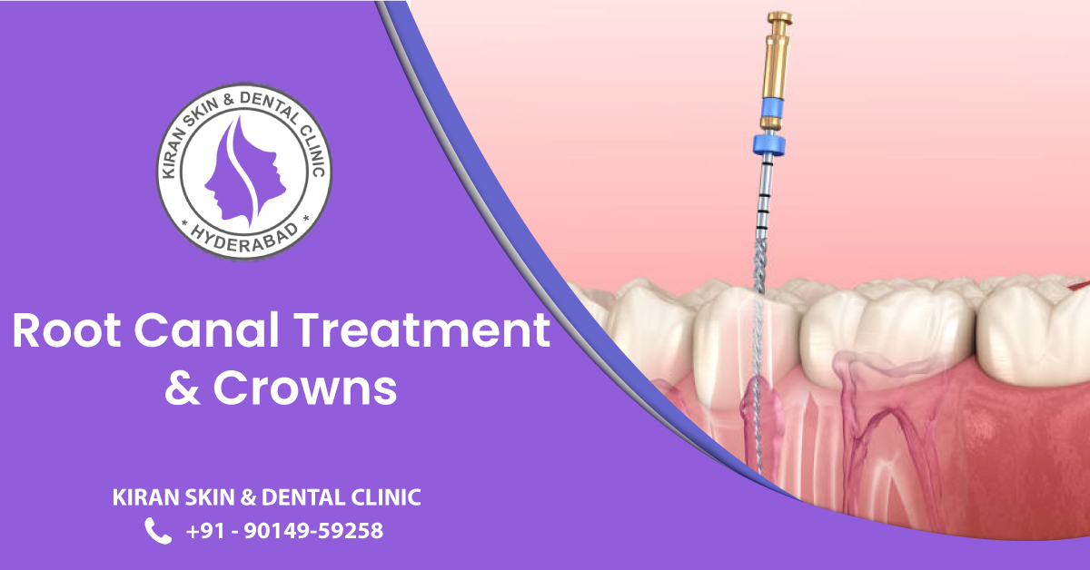Root_Canal_Treatment