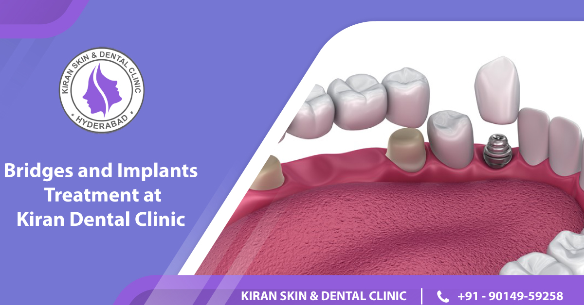 #BRIDGES-AND-IMPLANTS