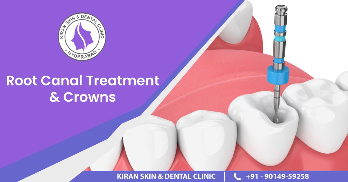 KDC_ROOT-CANAL-TREATMENT-&-CROWNS