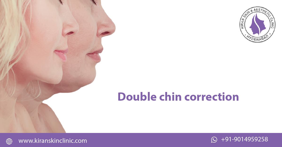 Double_chin_correction_treatement