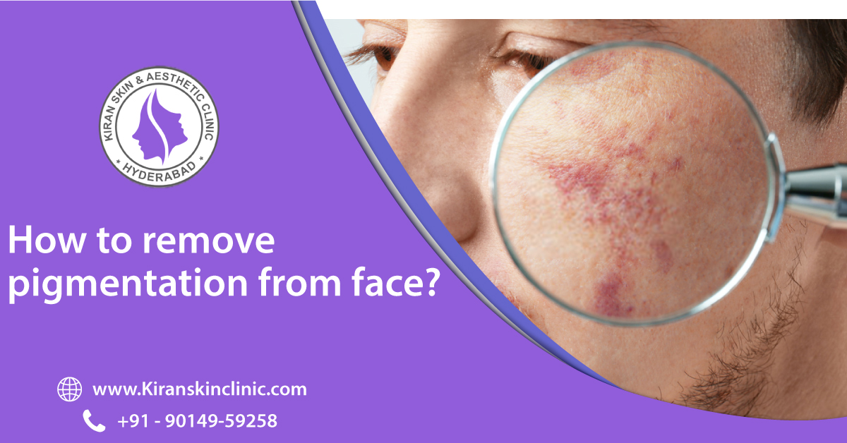 PIGMENTATION_TREATMENT