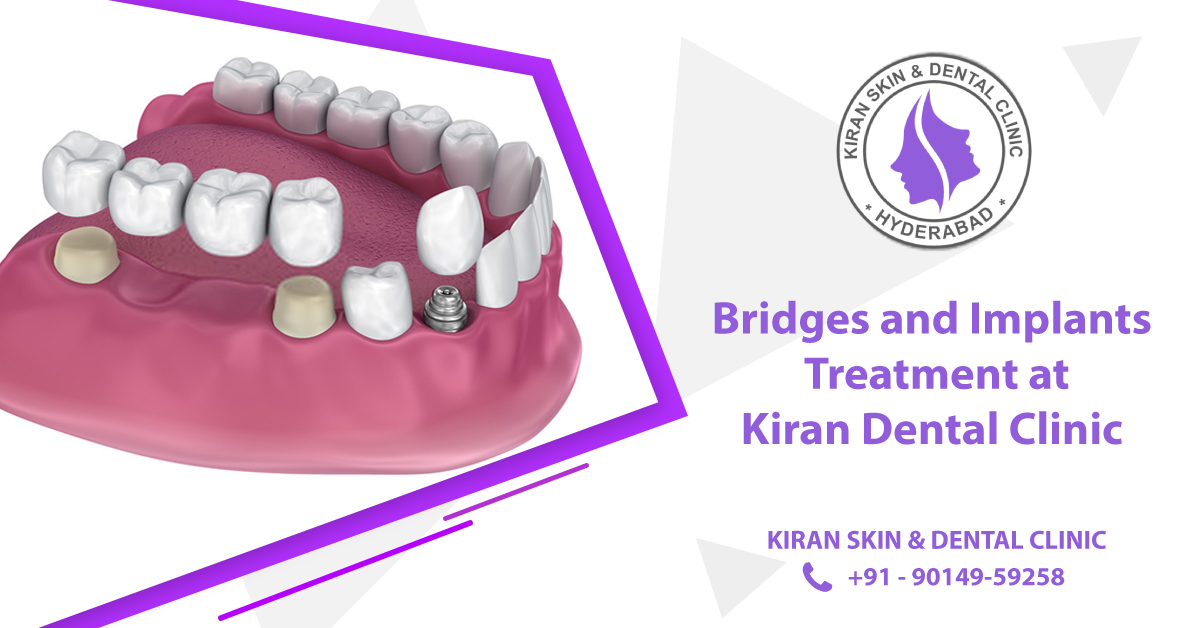 Bridges_and_Implants_Treatment_in_Hyderabad