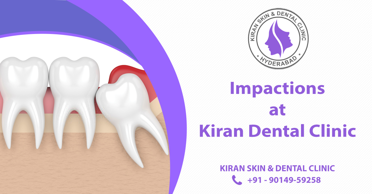 Tooth_Impactions_treatment