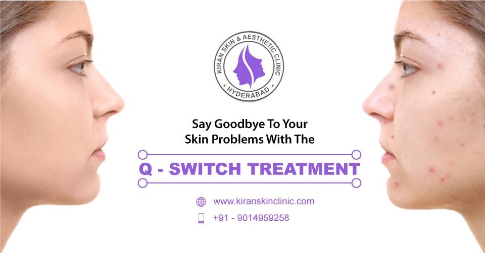 Q-Switch_Treatment_in_Hyderabad