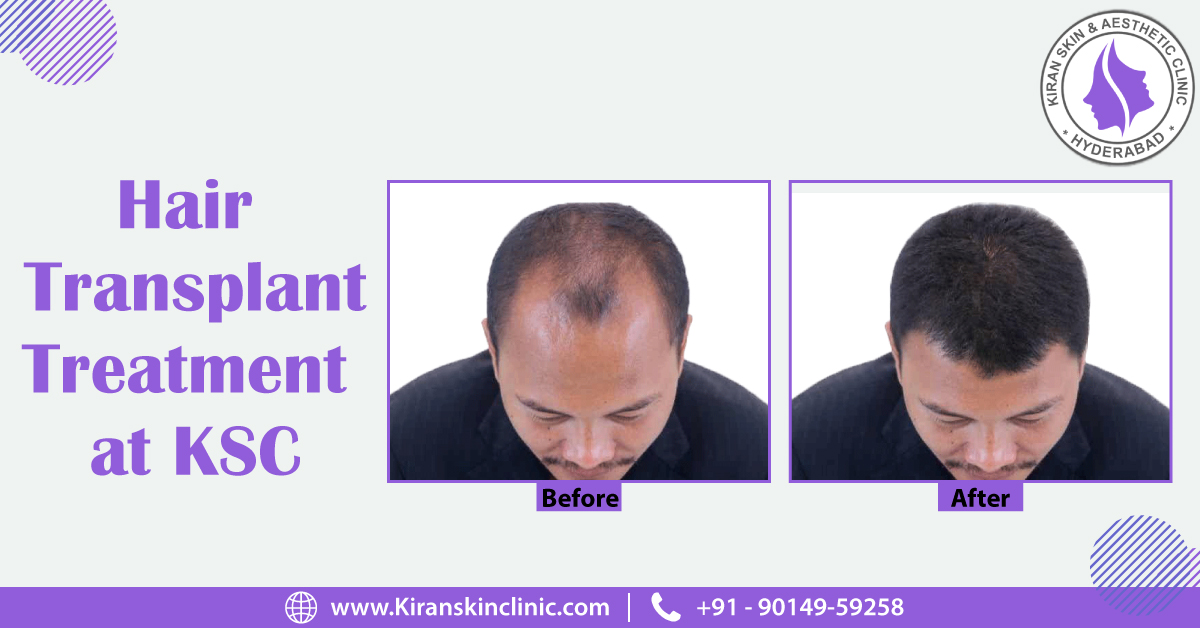 Hair_Transplant_Treatment_in_Hyderabad