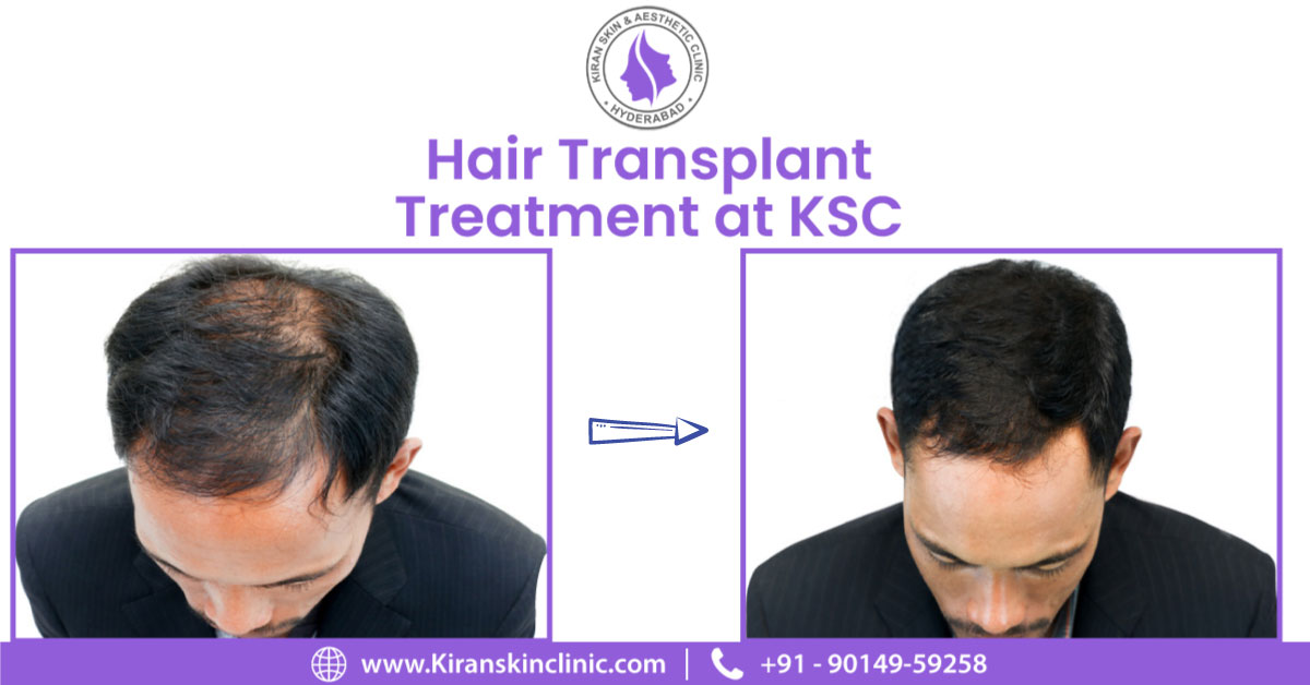 balding_head_treatment