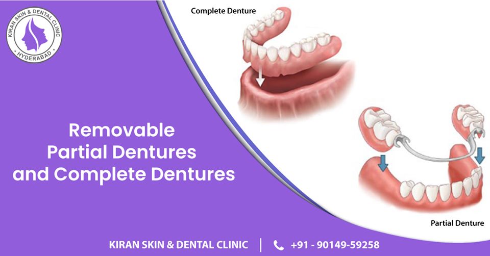 Removable_partial_dentures_and_complete_dentures Treatment