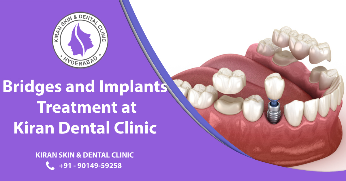 BRIDGES-AND-IMPLANTS