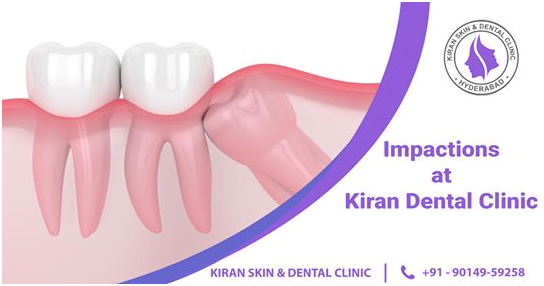 Tooth Impaction Surgery