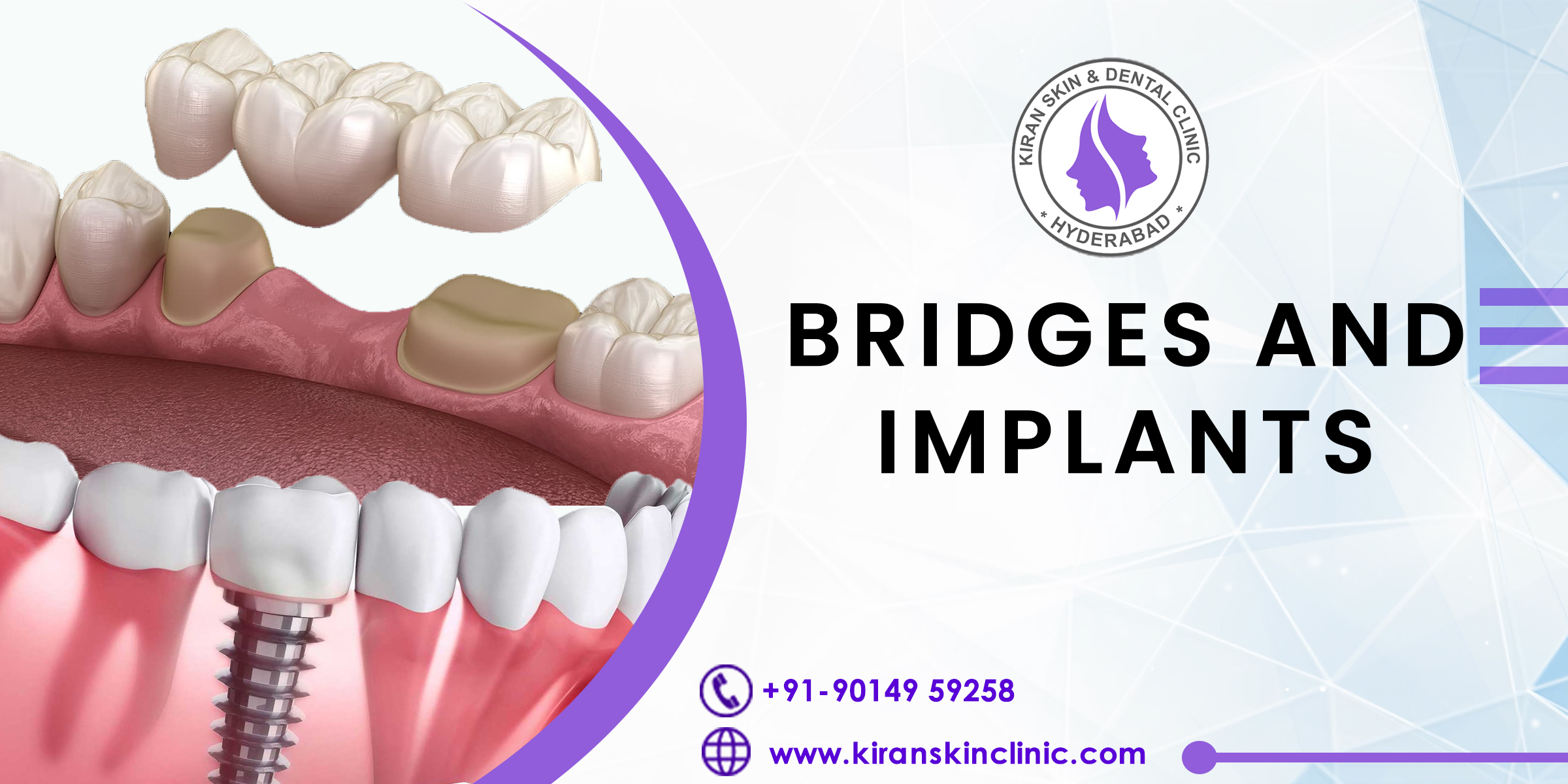 Bridges and Implants