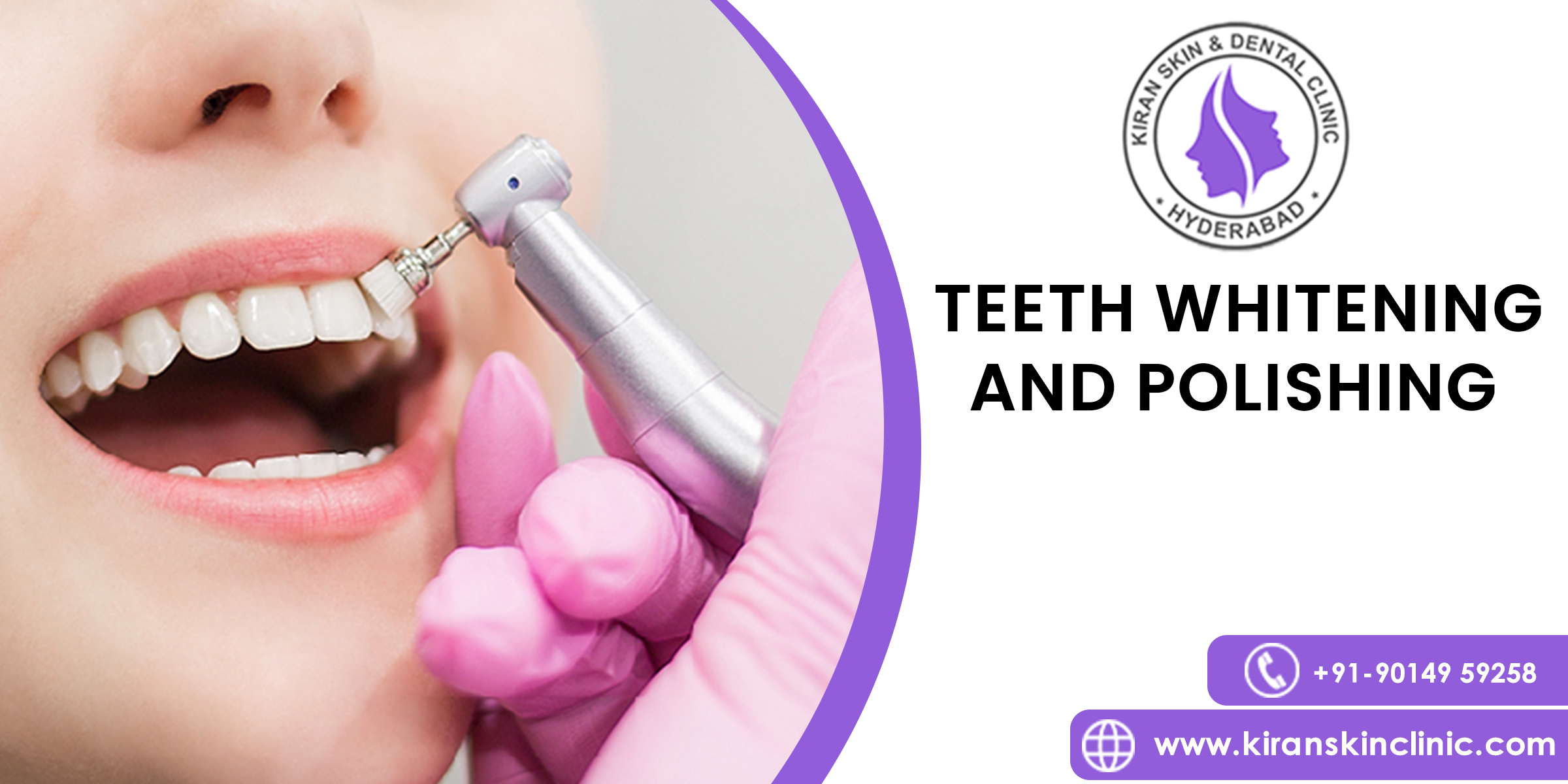 Teeth Whitening and Polishing