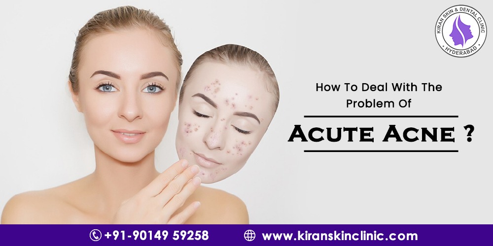 Acute Acne