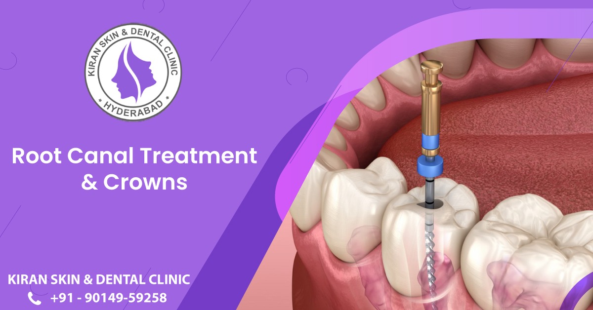 Root canal treatment at KDC