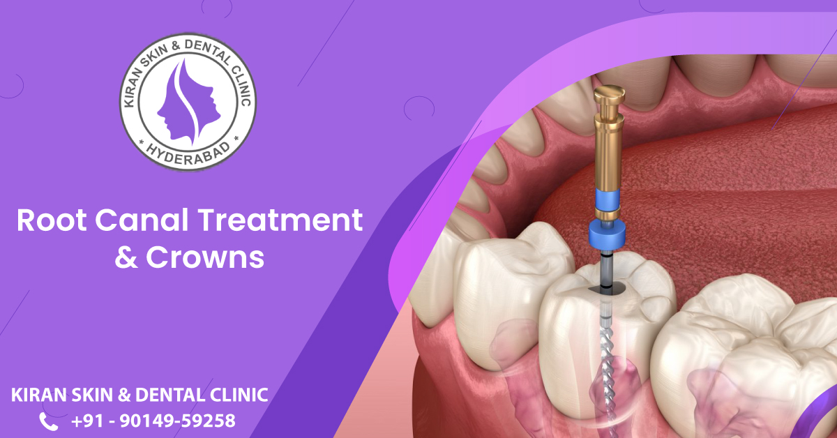 Root canal treatment